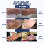 Eczema Therapy Cream - Image 4
