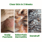 Scalp Thera Shampoo for Psoriasis, Seborrheic Dermatitis & Dandruff - Image 4