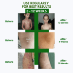 Psoriasis Cream Intensive Therapy PLUS + - Image 7